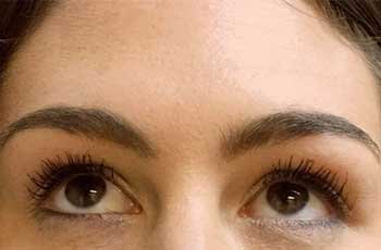 botox-after-01-newcrop