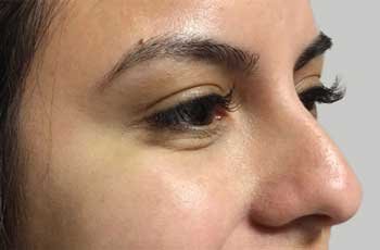 botox-after-02-newcrop