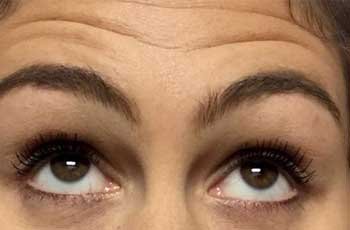 botox-before-01-newcrop1